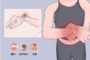 【健康科普系列二十】腕背腱鞘囊腫小知識